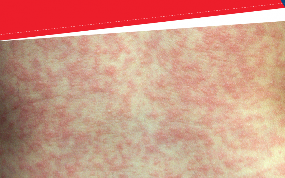 Health Alert – Measles Gold Coast & Logan